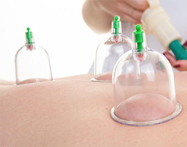 Cupping Therapy