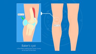 Baker Cyst