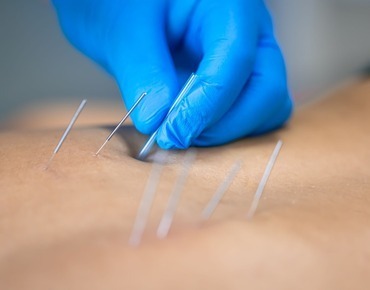 Dry Needling