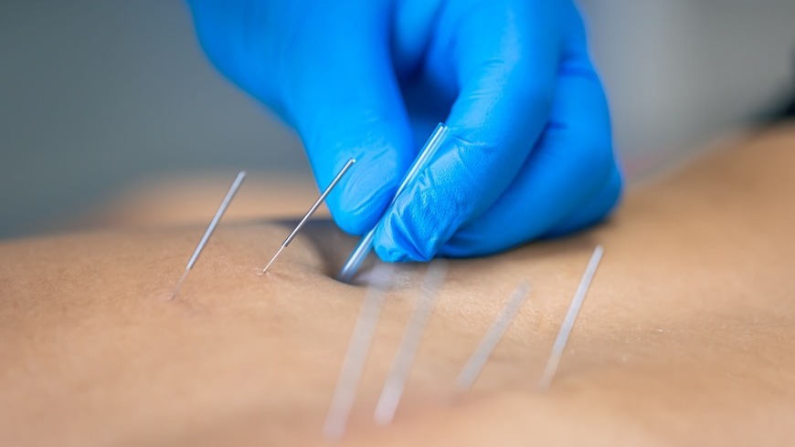 Dry Needling